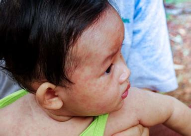 gamot sa peklat ng bata|6 na Paraan Para Magamot ang Shingles Sa Bahay .